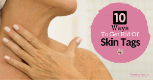 Best ways to get rid of skin tags