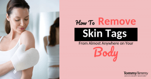 remove skin tags from anywhere on your body