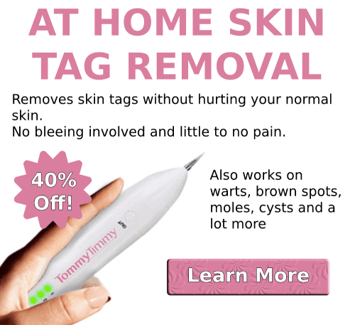 Remove Skin Tags!