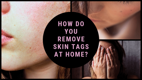 How Do You Remove Skin Tags At Home?