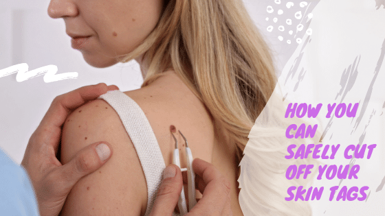 How You Can Safely Cut Off Skin Tags With Scissors
