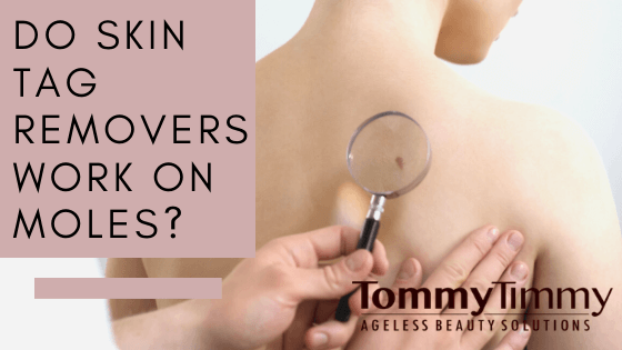 Do Skin Tag Removers Work On Moles?