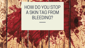 Stop a skin tag from bleeding