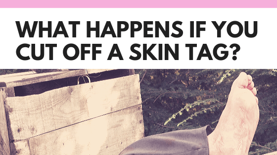What Happens If You Cut Off A Skin Tag?