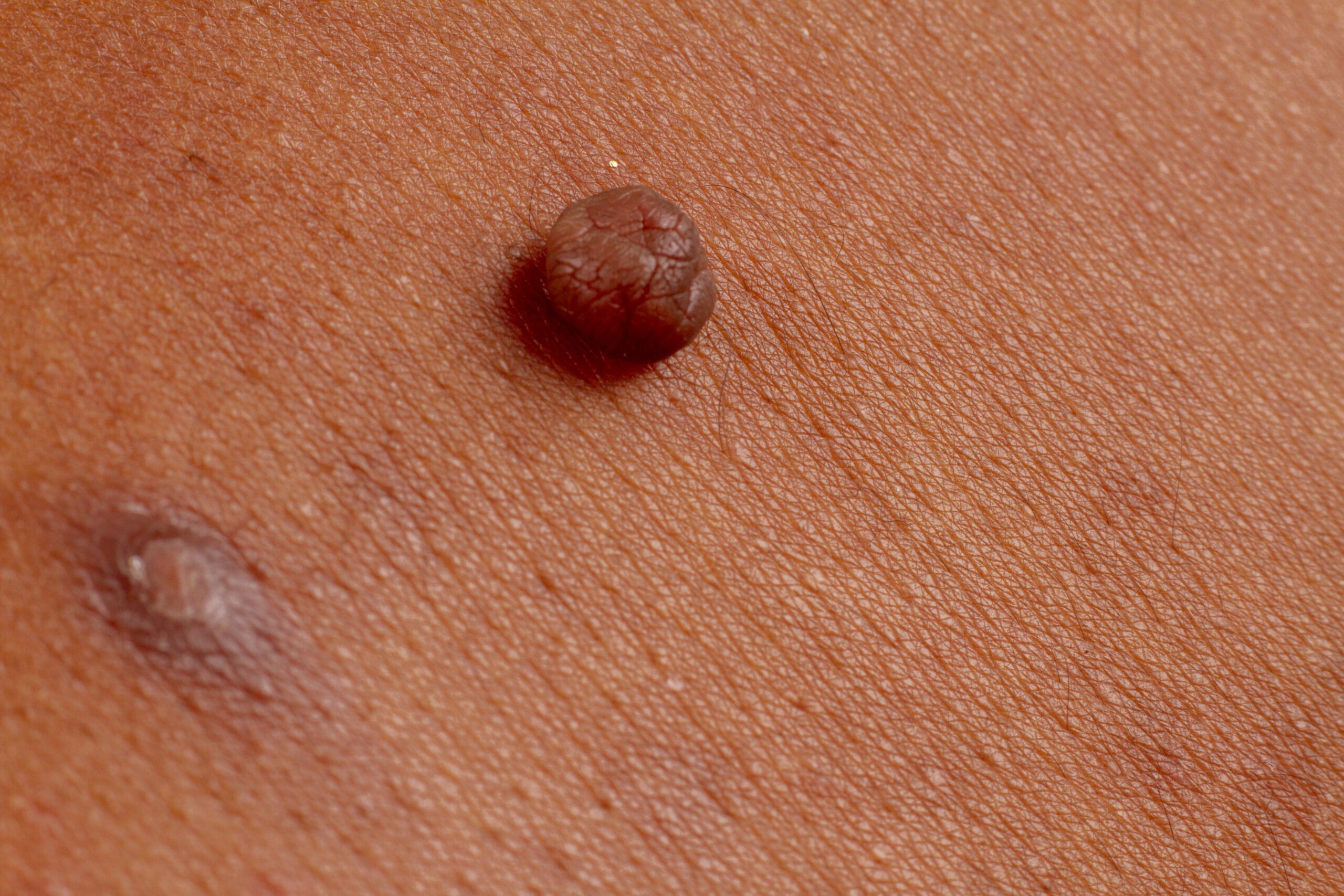 mole and wart on skin