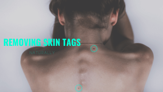 Natural Remedies For Removing Skin Tags