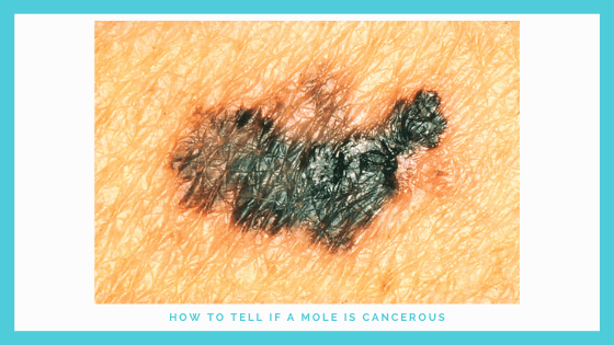 How To Tell If A Mole Is Cancerous