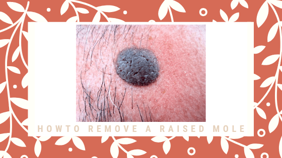 How To Remove A Raised Mole
