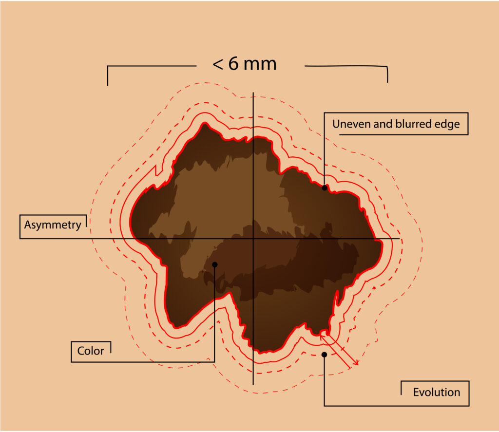 How To Tell If A Mole Is Cancerous