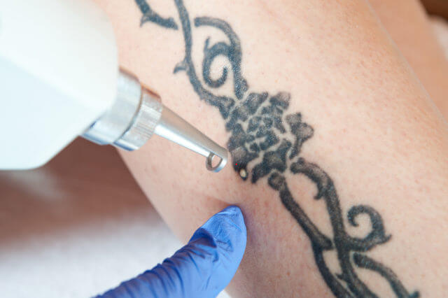 Tatto Removal With Lasers