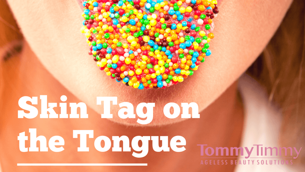 skin tag on tongue