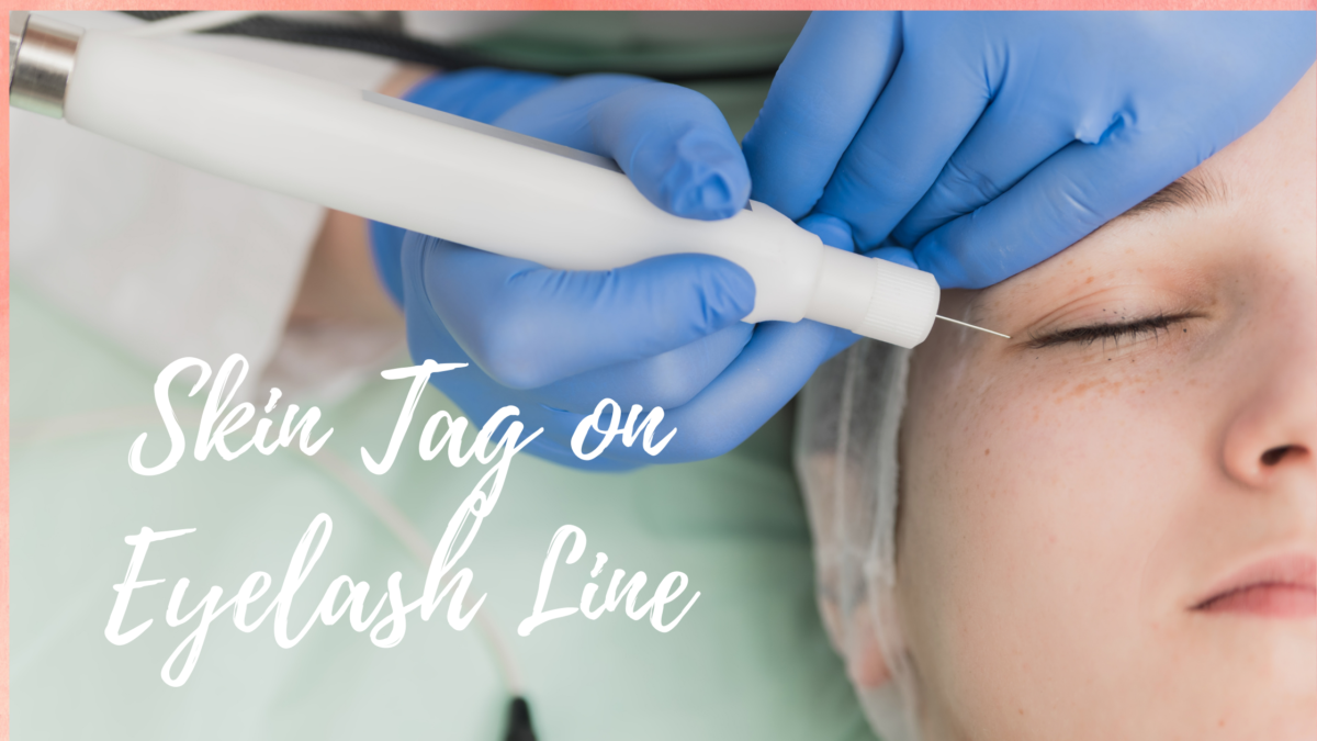 Skin Tag on Eyelash Line