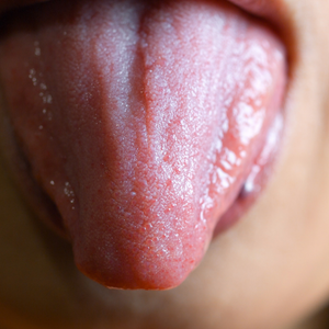 Damage on tongue