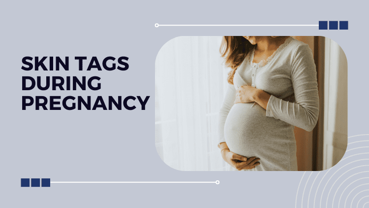 Skin Tags During Pregnancy