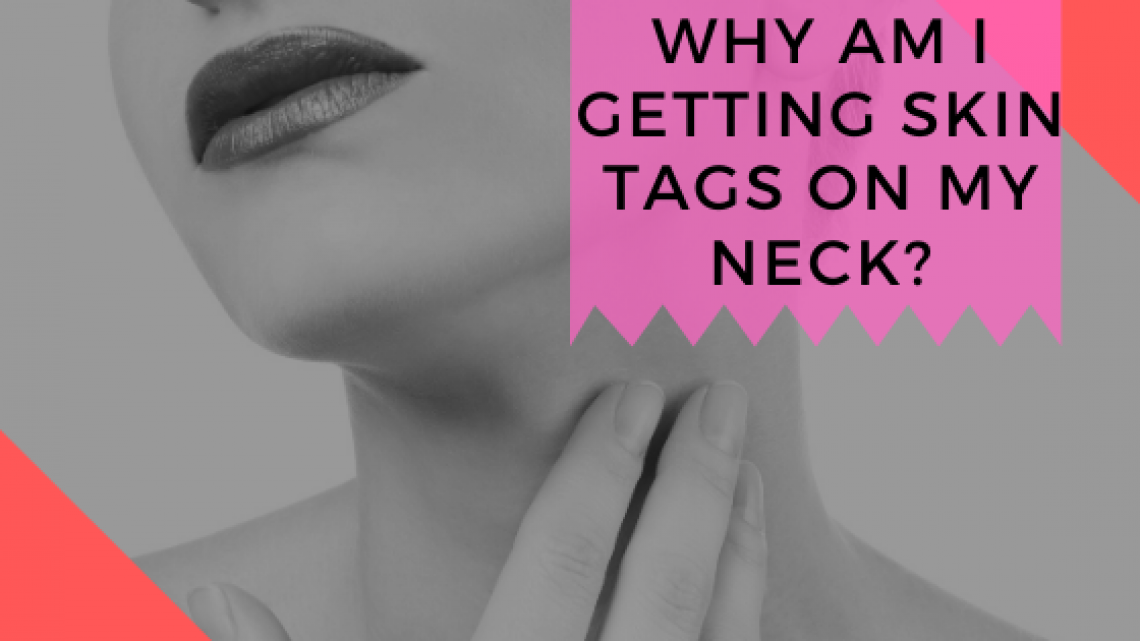 multiple skin tags on neck